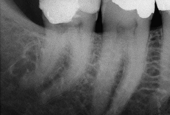 4.8-RX-preoperatoria